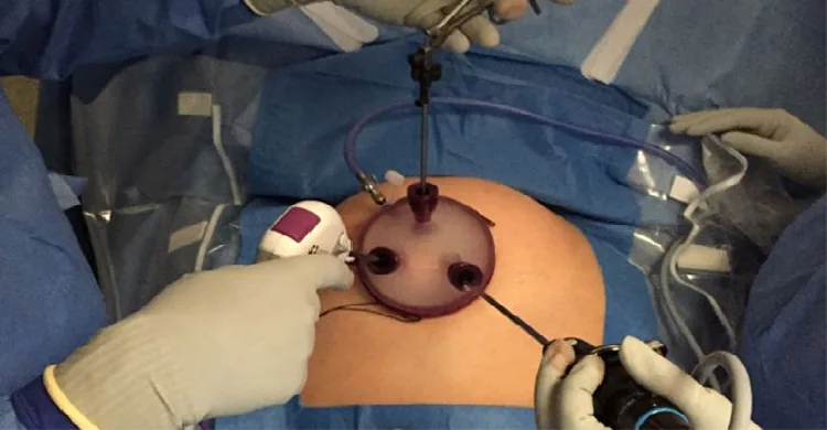 Advanced Laparoscopic Surgery