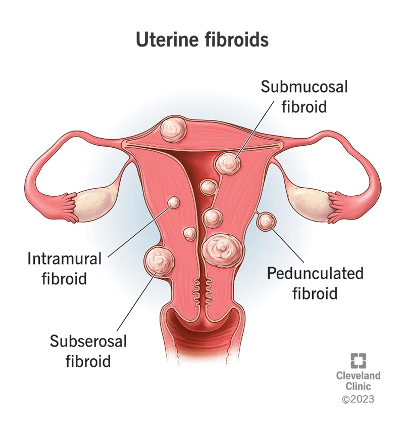 Fibroid Treatment
