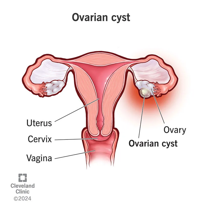 Ovarian Cyst Treatment