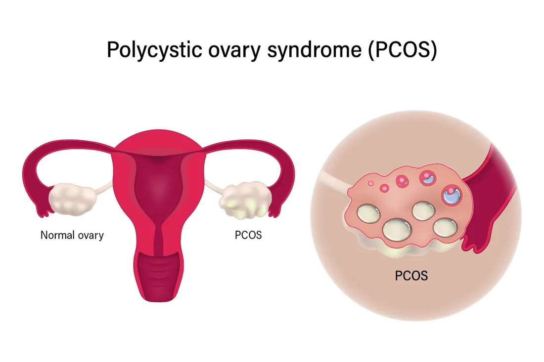 PCOS Management